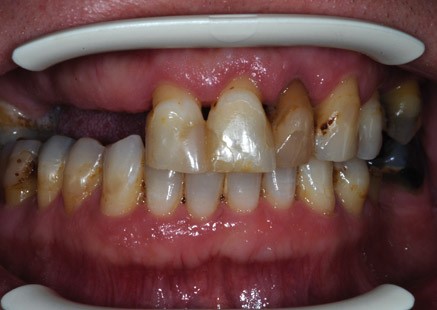 Partial 
      Dentures Before And After San Marino CA 91108